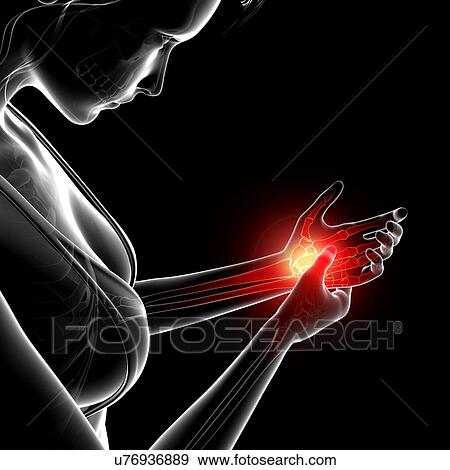 Stock Illustration - Wrist pain, artwork. Fotosearch