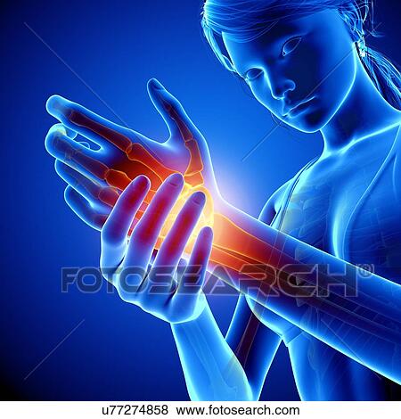 Wrist pain, artwork View Large Illustration Stock Illustration - Wrist pain, artwork. Fotosearch