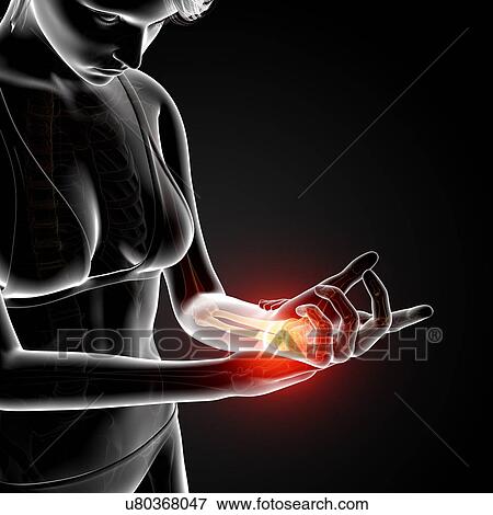 Wrist pain, artwork View Large Illustration Stock Illustration - Wrist pain, artwork. Fotosearch