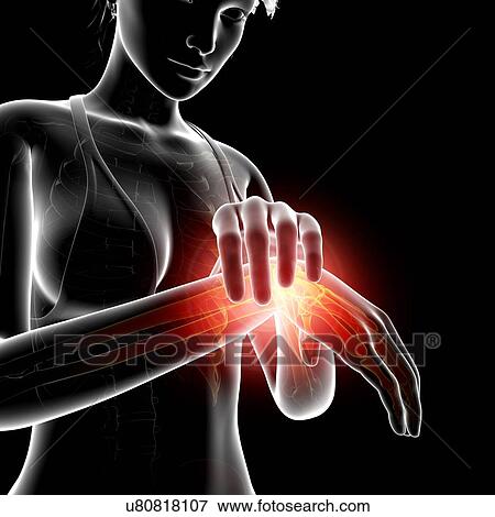 Stock Illustration - Wrist pain, artwork. Fotosearch