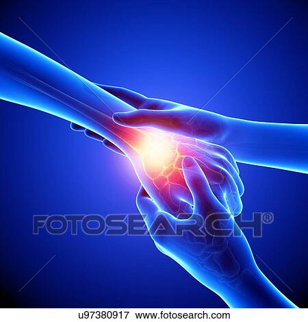 Wrist pain, artwork View Large Illustration Stock Illustration - Wrist pain, artwork. Fotosearch