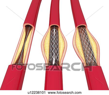 Angioplasty, artwork View Large Illustration Clip Art - Angioplasty, artwork. Fotosearch