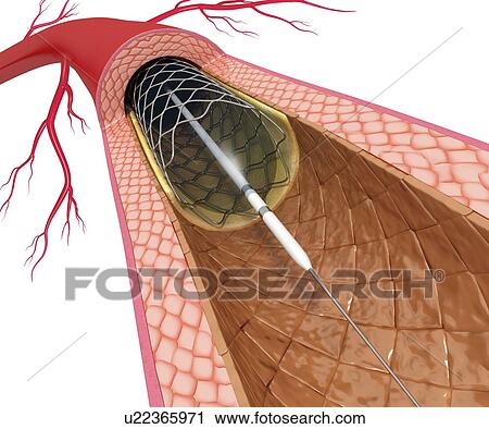 Clip Art - Angioplasty, artwork. Fotosearch