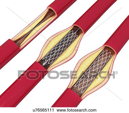 Angioplasty, artwork View Large Illustration Clip Art - Angioplasty, artwork. Fotosearch