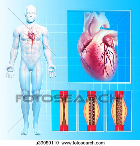 Angioplasty, artwork View Large Illustration Clipart - Angioplasty, artwork. Fotosearch