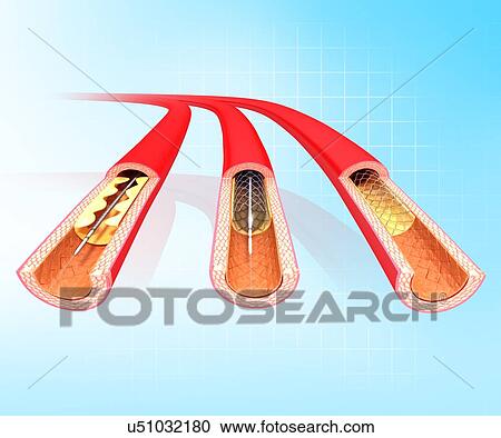 Angioplasty, artwork View Large Illustration Clipart - Angioplasty, artwork. Fotosearch