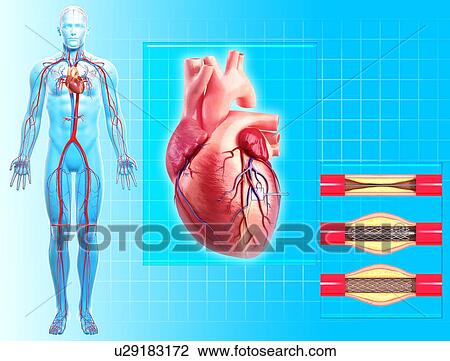 Drawing - Angioplasty, artwork. Fotosearch