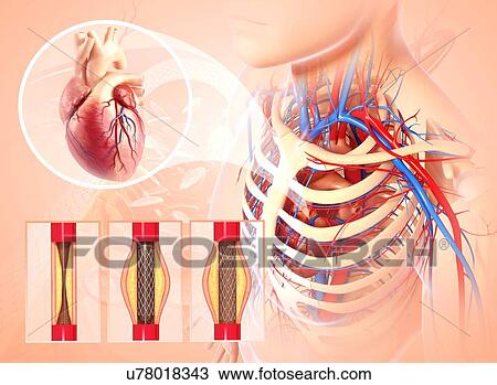 Drawing - Angioplasty, artwork. Fotosearch