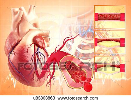 Angioplasty, artwork View Large Illustration Drawing - Angioplasty, artwork. Fotosearch