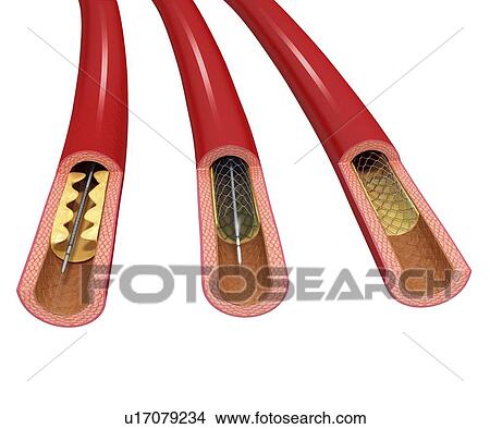 Angioplasty, artwork View Large Illustration Stock Illustration - Angioplasty, artwork. Fotosearch