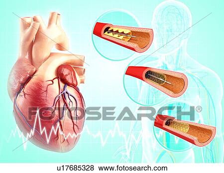 Angioplasty, artwork View Large Illustration Stock Illustration - Angioplasty, artwork. Fotosearch