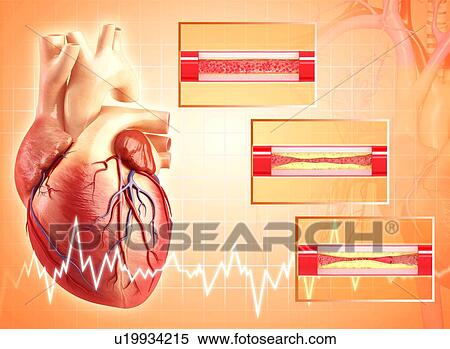 Angioplasty, artwork View Large Illustration Stock Illustration - Angioplasty, artwork. Fotosearch