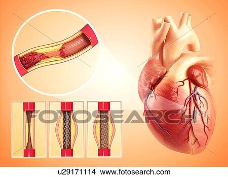 Angioplasty, artwork View Large Illustration Stock Illustration - Angioplasty, artwork. Fotosearch
