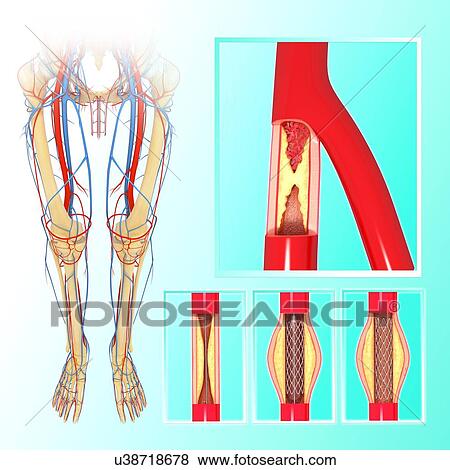 Angioplasty, artwork View Large Illustration Stock Illustration - Angioplasty, artwork. Fotosearch