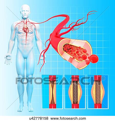 Angioplasty, artwork View Large Illustration Stock Illustration - Angioplasty, artwork. Fotosearch