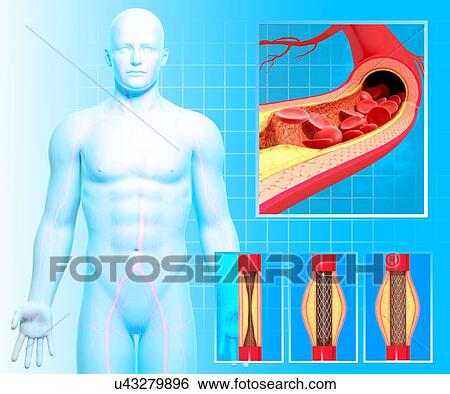 Stock Illustration - Angioplasty, artwork. Fotosearch