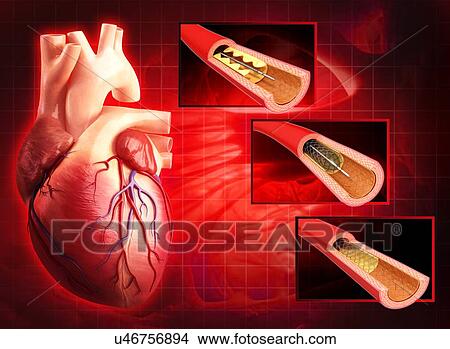 Stock Illustration - Angioplasty, artwork. Fotosearch