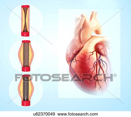 Stock Illustration - Angioplasty, artwork. Fotosearch