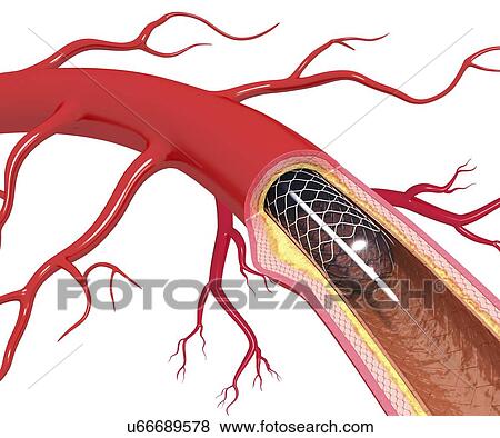 Angioplasty, artwork View Large Illustration Stock Illustration - Angioplasty, artwork. Fotosearch
