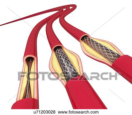Stock Illustration - Angioplasty, artwork. Fotosearch