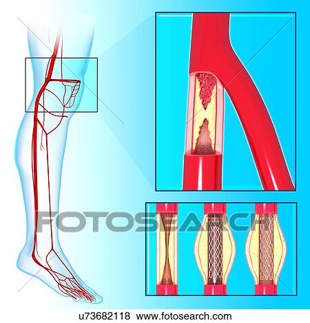Stock Illustration - Angioplasty, artwork. Fotosearch
