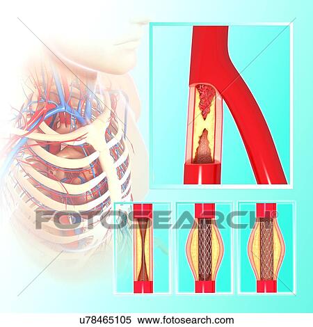 Stock Illustration - Angioplasty, artwork. Fotosearch