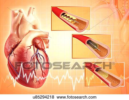 Angioplasty, artwork View Large Illustration Stock Illustration - Angioplasty, artwork. Fotosearch