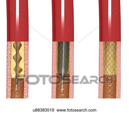 Stock Illustration - Angioplasty, artwork. Fotosearch