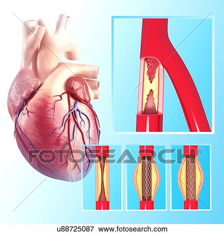 Stock Illustration - Angioplasty, artwork. Fotosearch