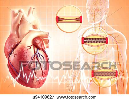 Angioplasty, artwork View Large Illustration Stock Illustration - Angioplasty, artwork. Fotosearch