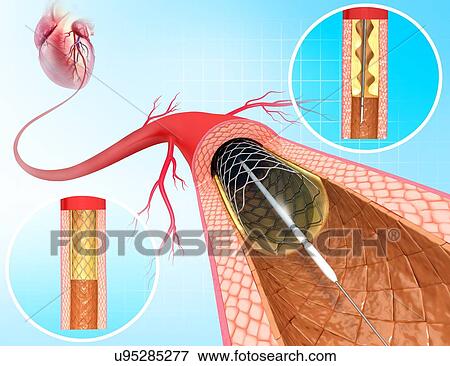 Stock Illustration - Angioplasty, artwork. Fotosearch