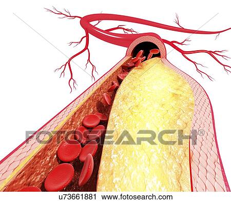 Atherosclerosis, artwork View Large Illustration Clip Art - Atherosclerosis, artwork. Fotosearch