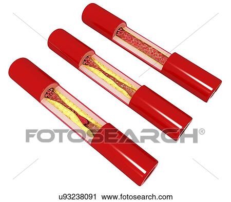 Atherosclerosis, artwork View Large Illustration Clip Art - Atherosclerosis, artwork. Fotosearch