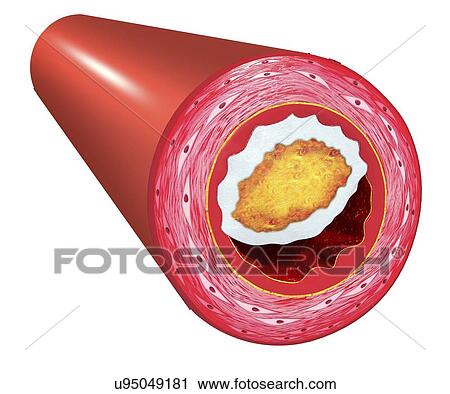 Atherosclerosis, artwork View Large Illustration Clip Art - Atherosclerosis, artwork. Fotosearch