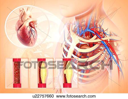 Atherosclerosis, artwork View Large Illustration Clipart - Atherosclerosis, artwork. Fotosearch