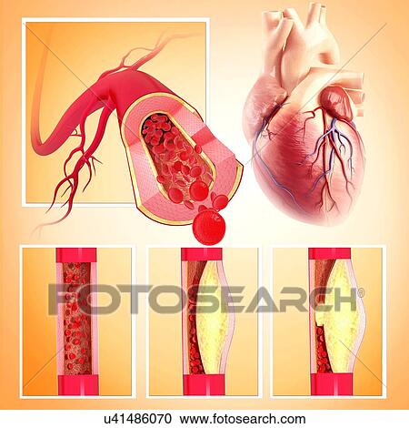 Atherosclerosis, artwork View Large Illustration Clipart - Atherosclerosis, artwork. Fotosearch