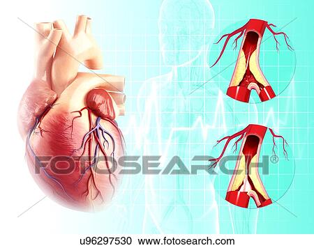 Clipart - Atherosclerosis, artwork. Fotosearch
