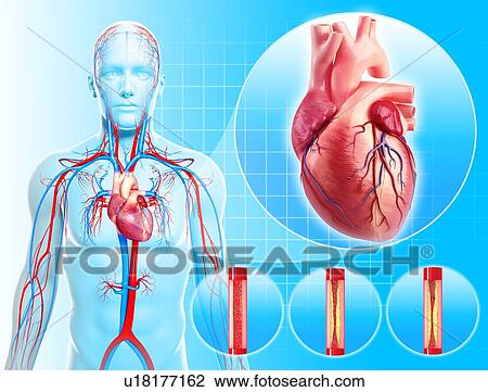 Atherosclerosis, artwork View Large Illustration Drawing - Atherosclerosis, artwork. Fotosearch