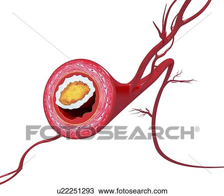 Atherosclerosis, artwork View Large Illustration Drawing - Atherosclerosis, artwork. Fotosearch
