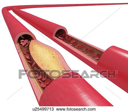 Drawing - Atherosclerosis, artwork. Fotosearch