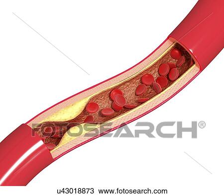 Atherosclerosis, artwork View Large Illustration Drawing - Atherosclerosis, artwork. Fotosearch