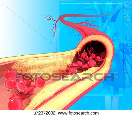Drawing - Atherosclerosis, artwork. Fotosearch