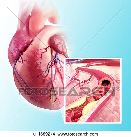 Stock Illustration - Atherosclerosis, artwork. Fotosearch
