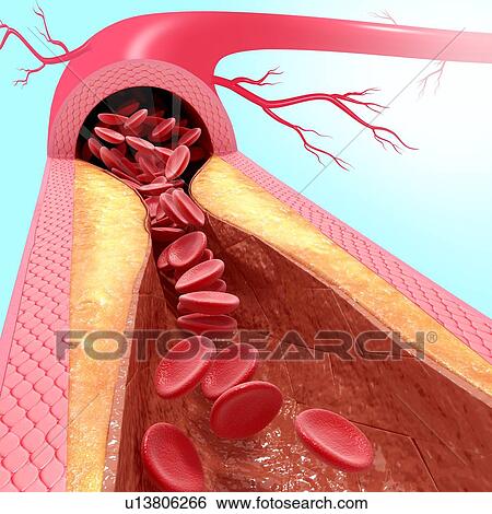 Stock Illustration - Atherosclerosis, artwork. Fotosearch
