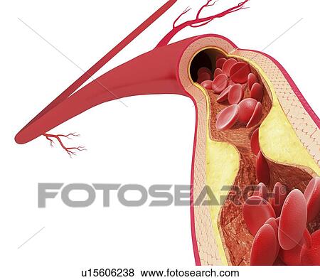 Stock Illustration - Atherosclerosis, artwork. Fotosearch
