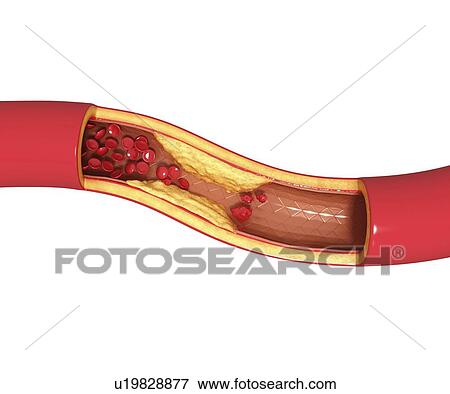 Stock Illustration - Atherosclerosis, artwork. Fotosearch