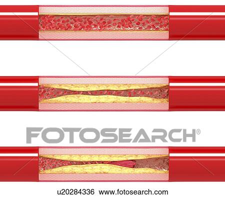 Atherosclerosis, artwork View Large Illustration Stock Illustration - Atherosclerosis, artwork. Fotosearch