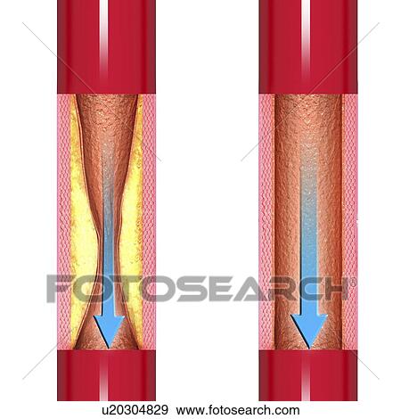Atherosclerosis, artwork View Large Illustration Stock Illustration - Atherosclerosis, artwork. Fotosearch