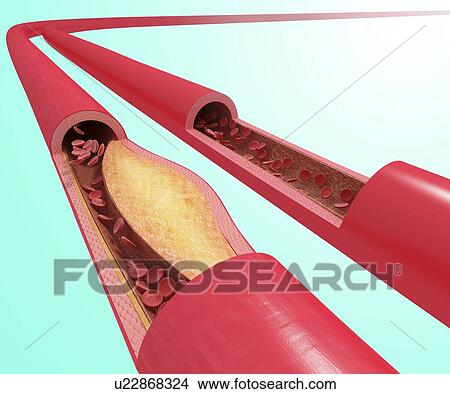 Atherosclerosis, artwork View Large Illustration Stock Illustration - Atherosclerosis, artwork. Fotosearch