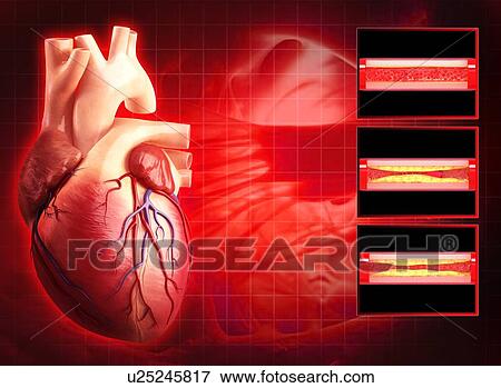 Atherosclerosis, artwork View Large Illustration Stock Illustration - Atherosclerosis, artwork. Fotosearch
